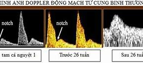 Siêu Âm Doppler Động Mạch Tử Cung